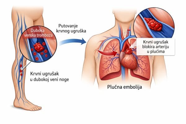 Plućna embolija